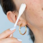 Consejos y métodos para tratar el acné